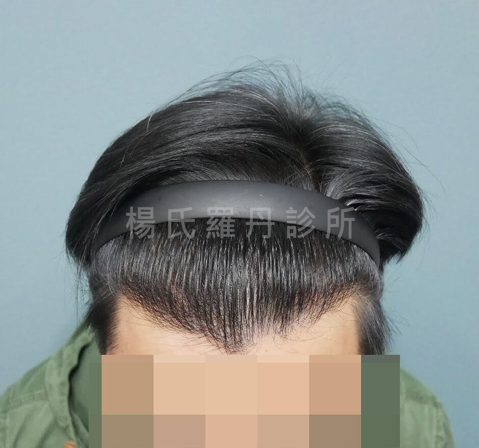 植髮 植髮手術
