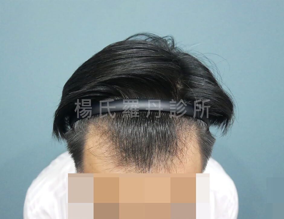 植髮 M型禿
