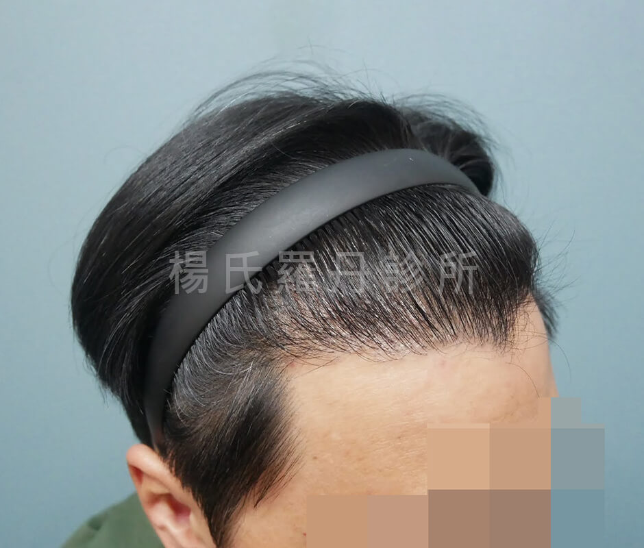 植髮 髮際線