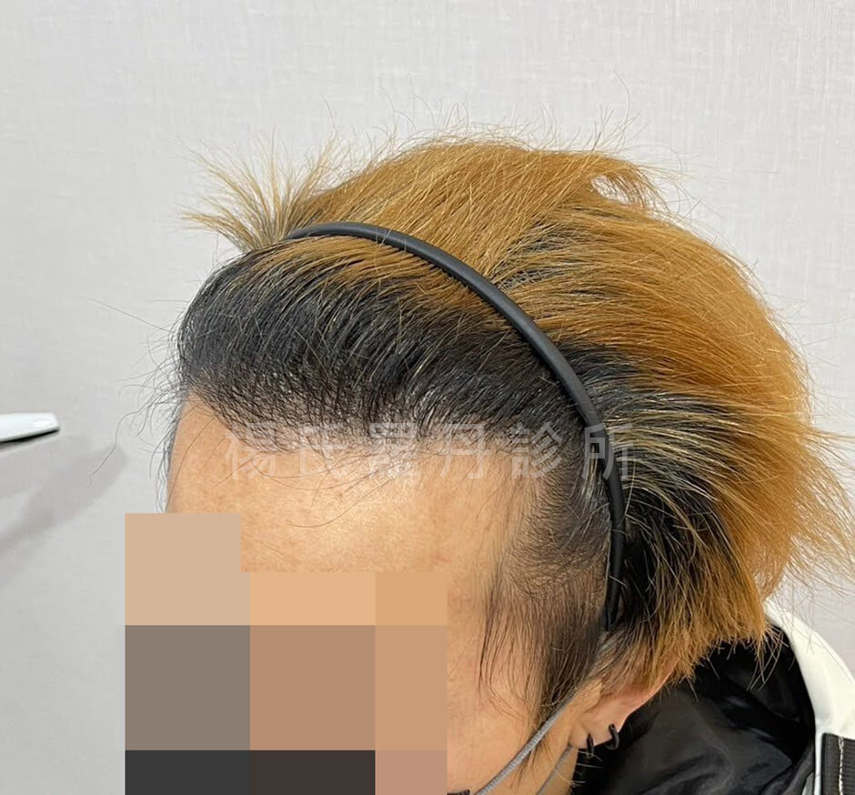 植髮 髮際線