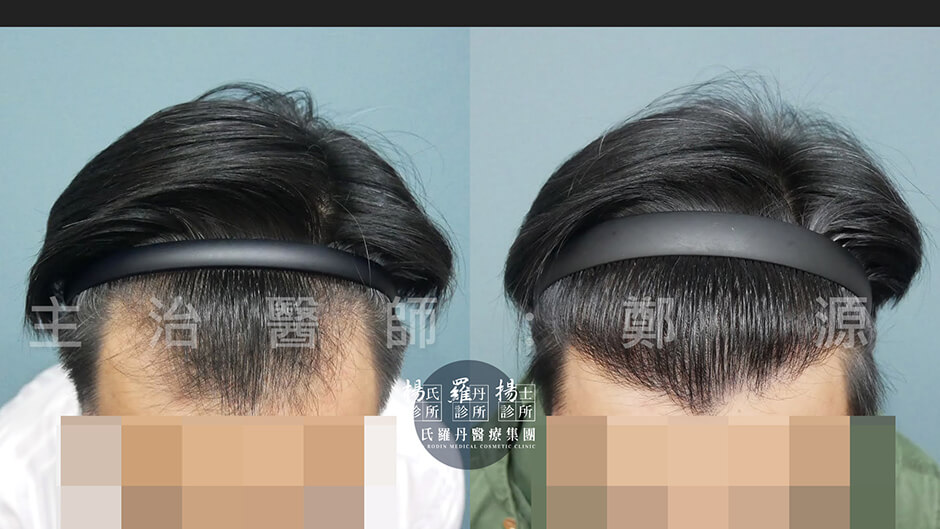 植髮 M型禿 植髮手術