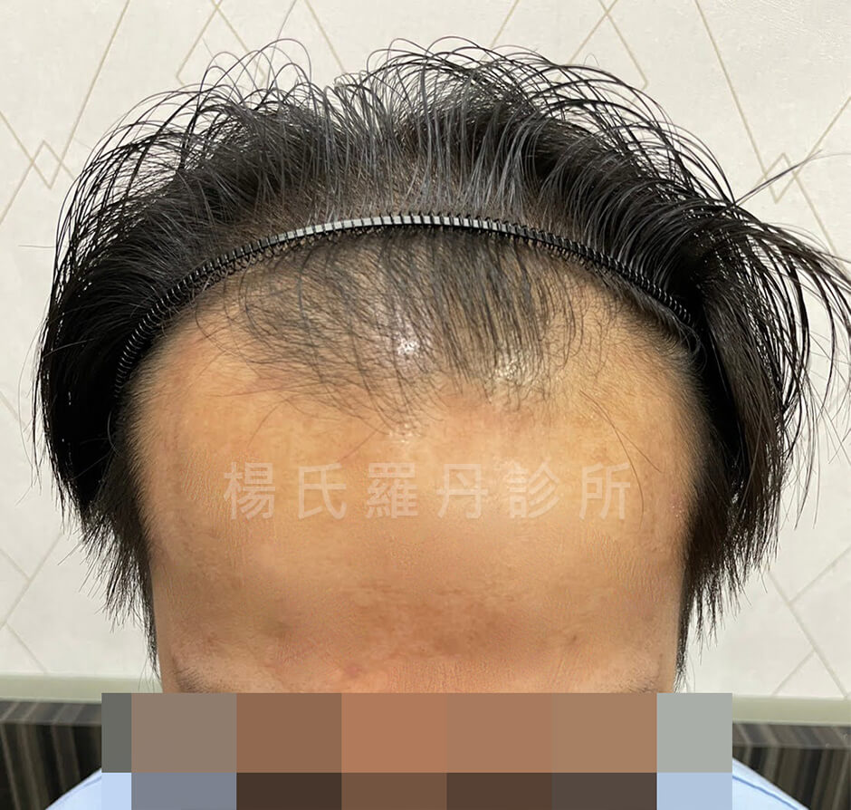 植髮 雄性禿