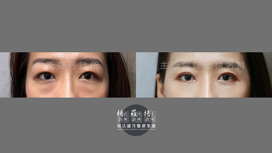 楊氏羅丹 眼袋消除 眼袋