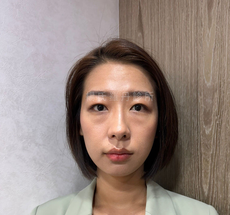 雙眼皮 泡泡眼