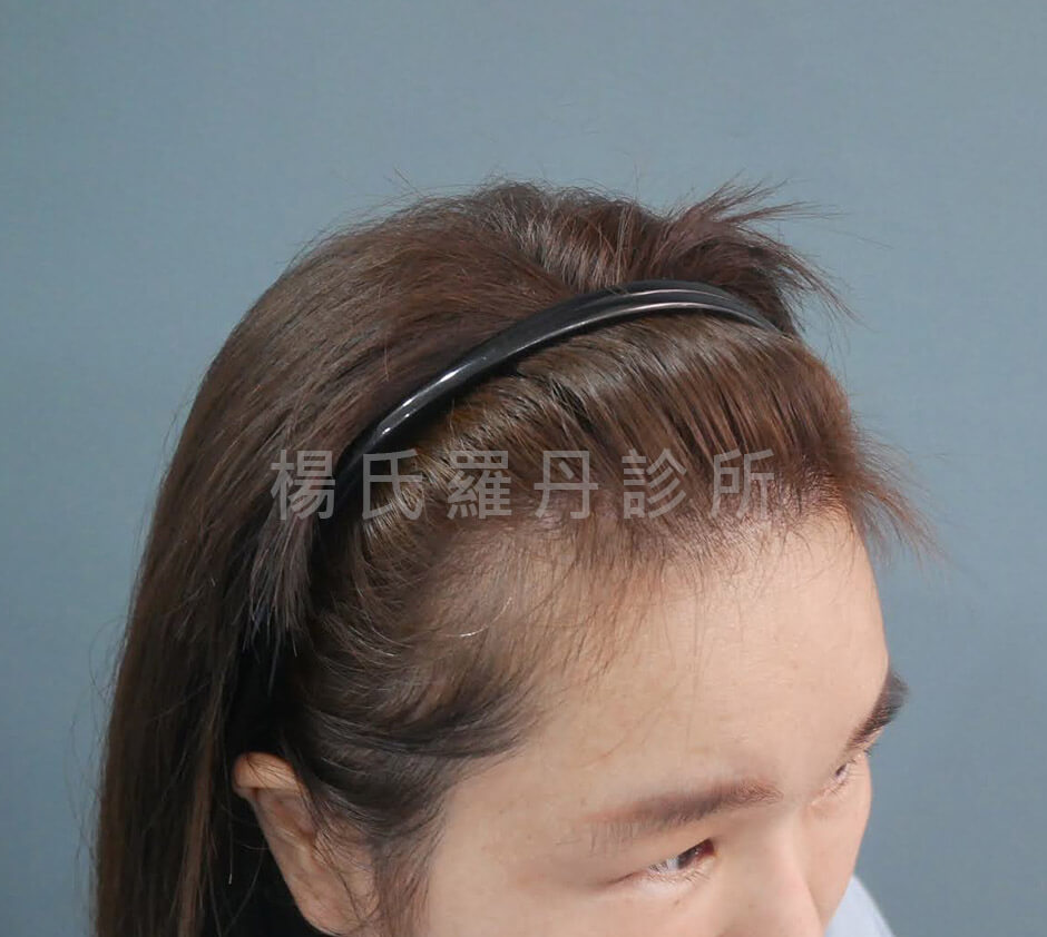 女性植髮 植髮手術
