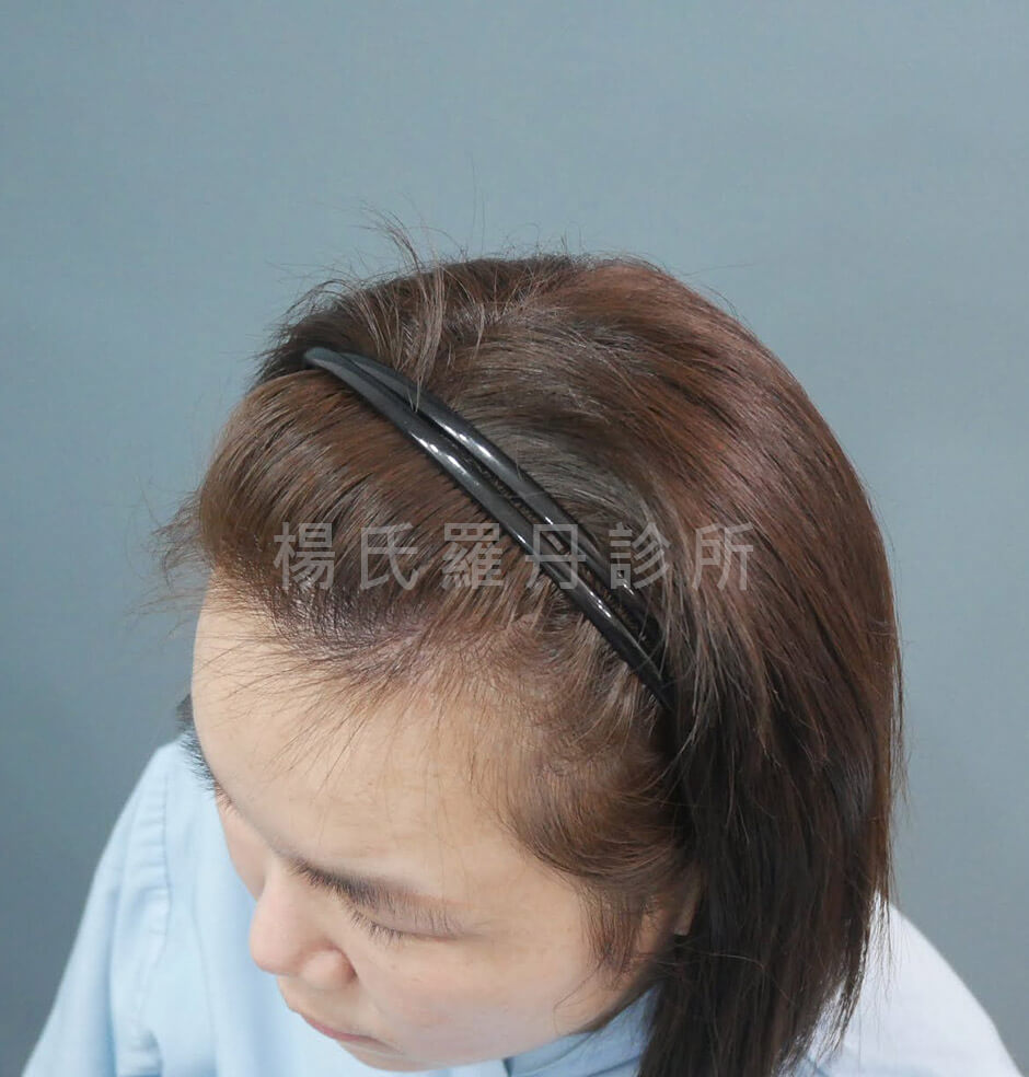 女性植髮 髮際線