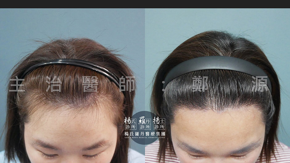 女性植髮 植髮 髮際線