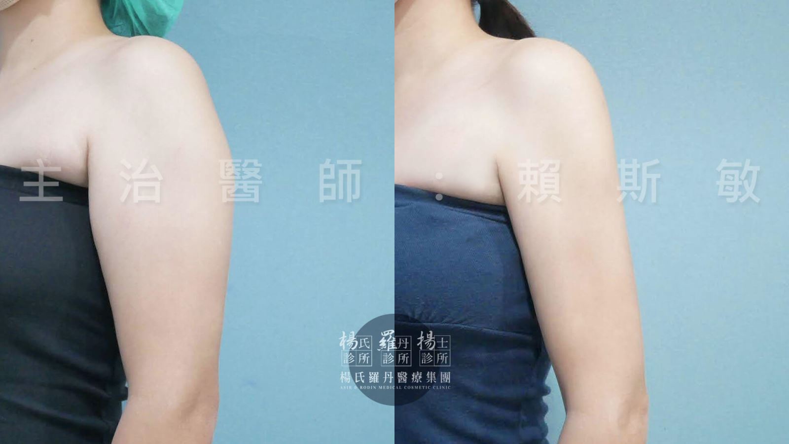 手臂抽脂 雷射減脂 瘦手臂