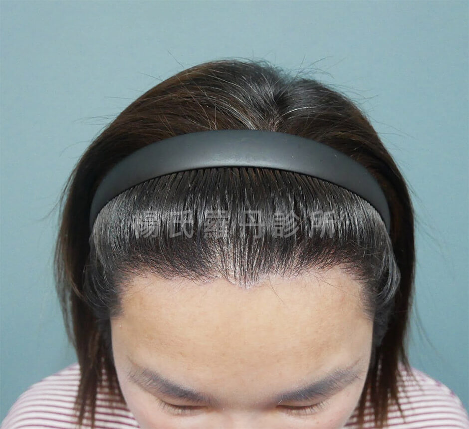 女性植髮 植髮