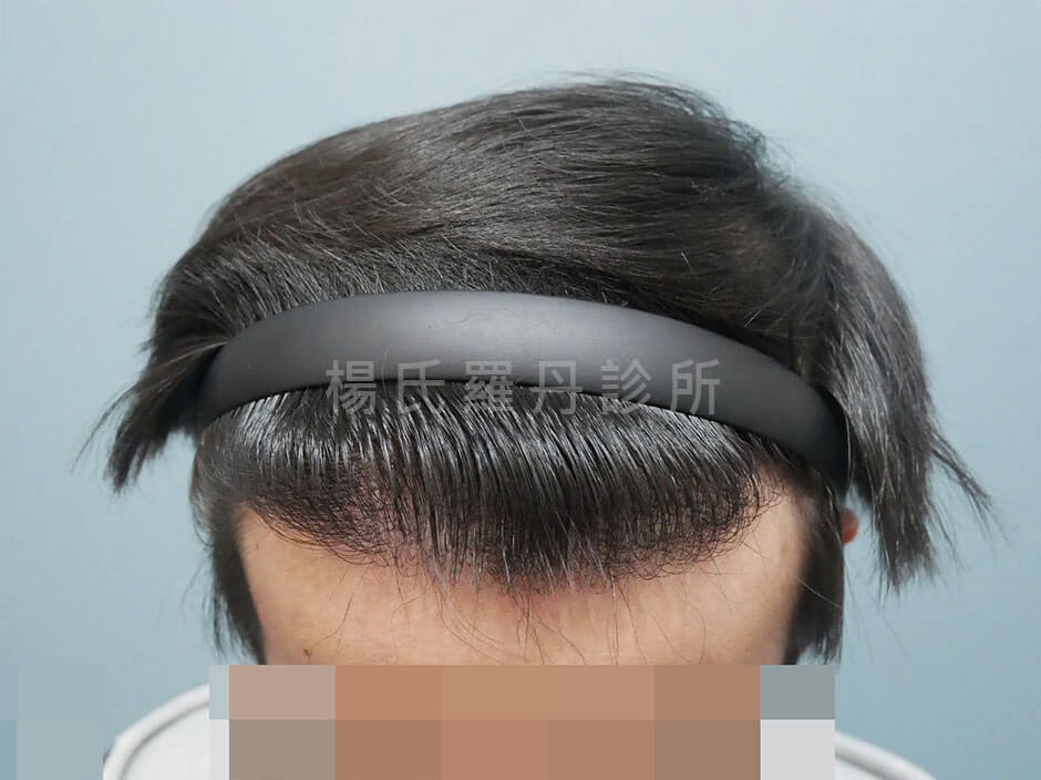 植髮 植髮手術