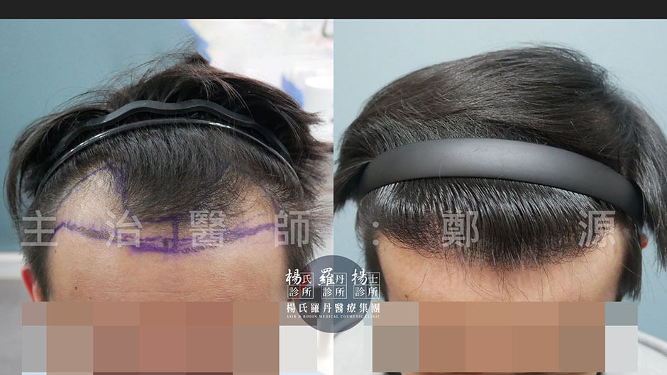 植髮 植髮效果 植髮手術
