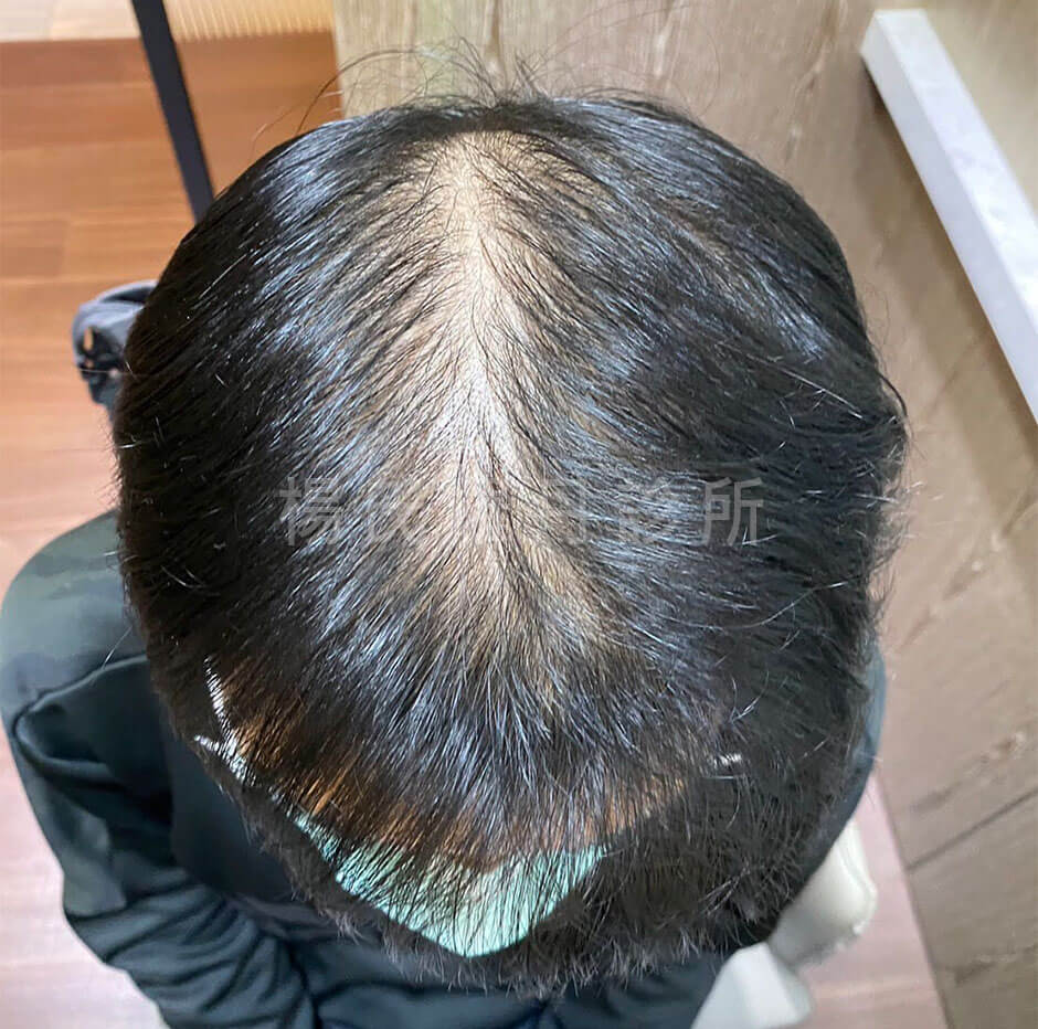 生髮 生髮治療