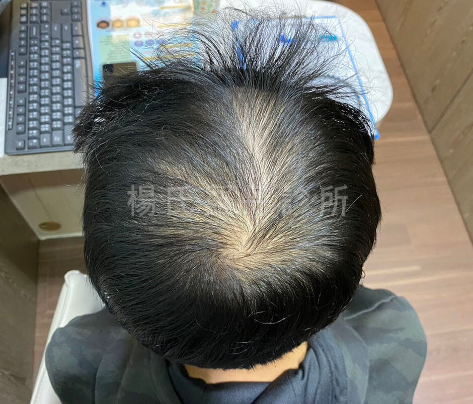 生髮 生髮療程