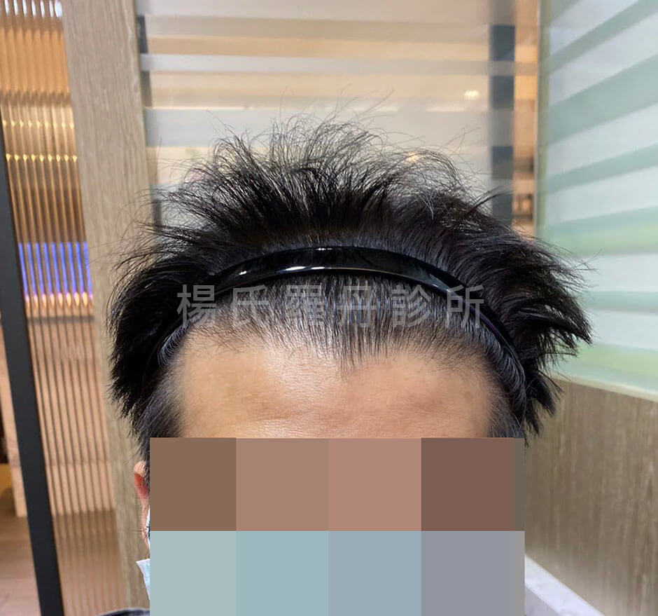 生髮 禿頭