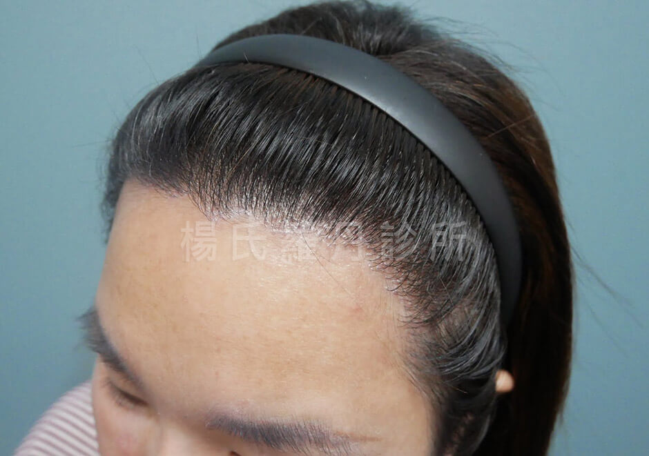 女性植髮 FUE植髮