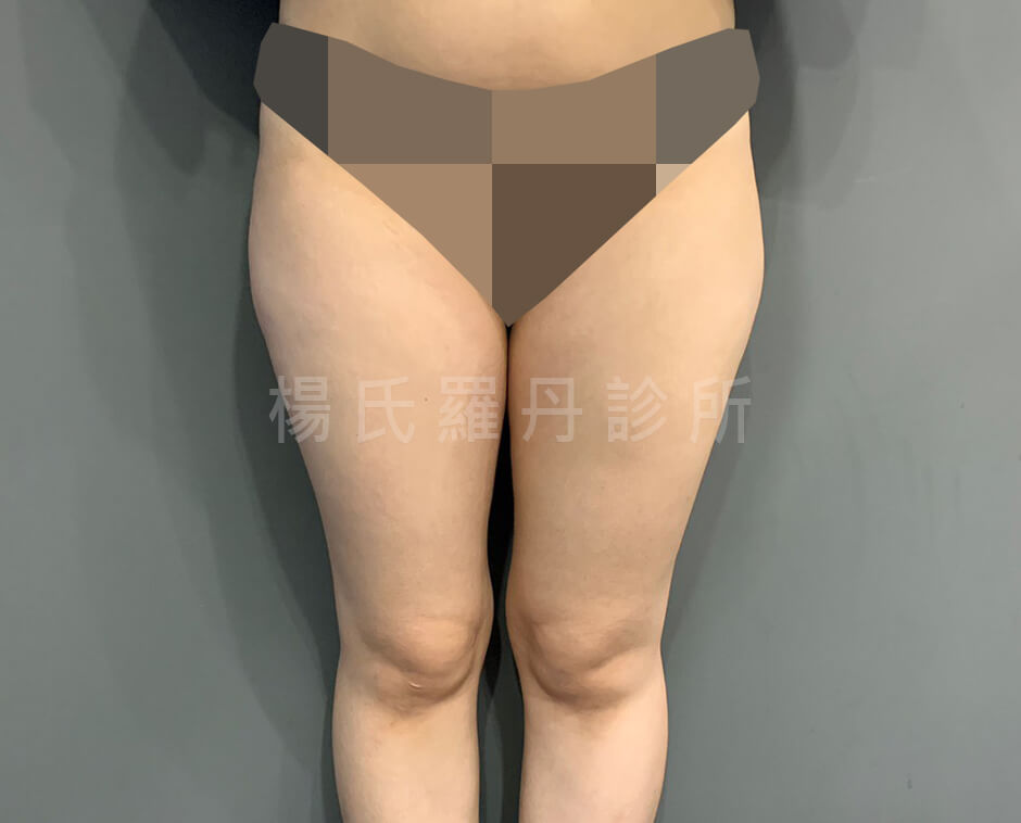 大腿抽脂 抽脂