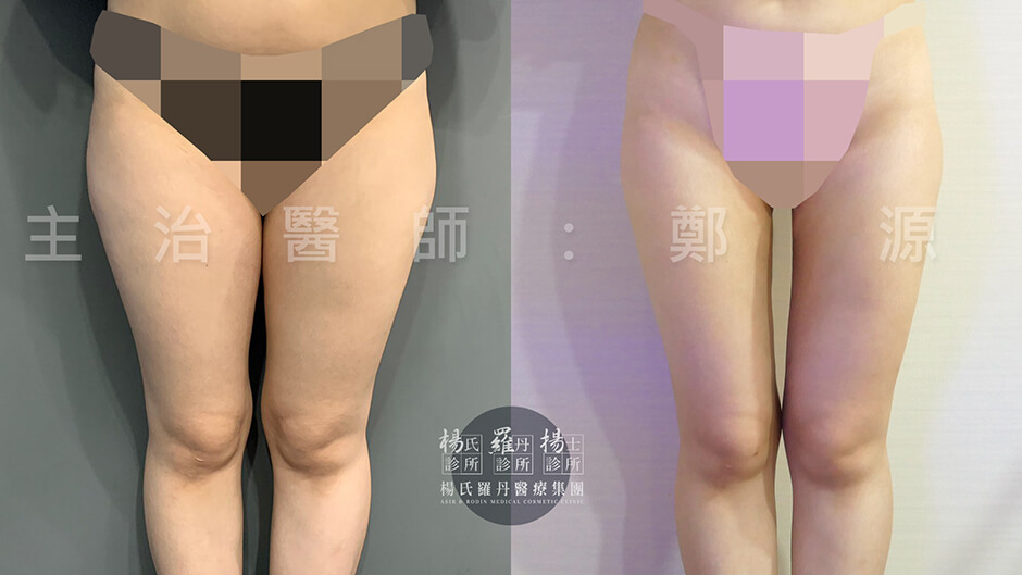大腿抽脂 抽脂 雷射減脂