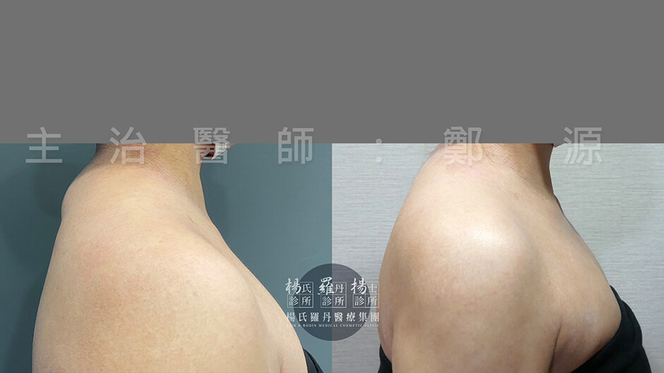 後頸抽脂 手臂抽脂