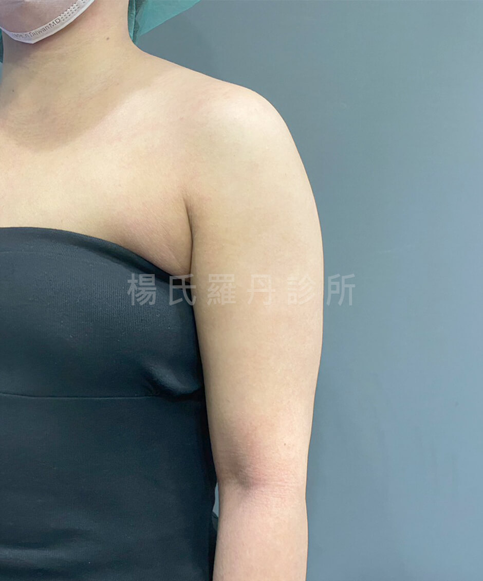 手臂抽脂 抽脂