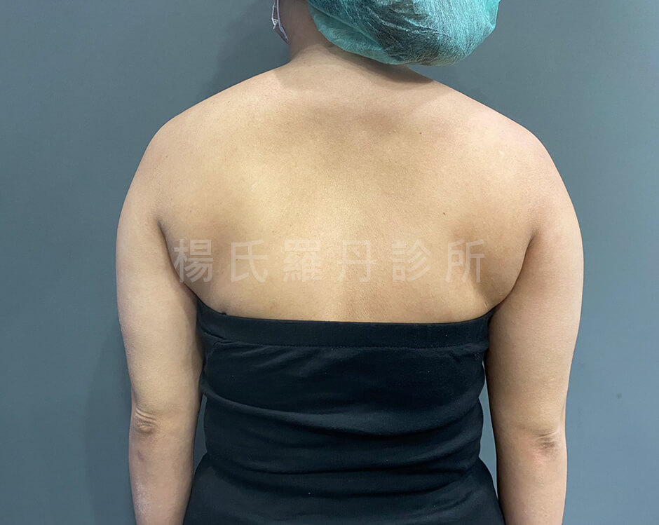 雷射減脂 瘦手臂