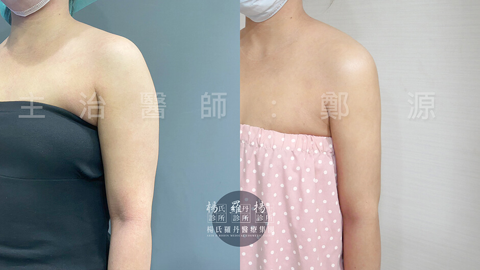 手臂抽脂 雷射減脂 瘦手臂