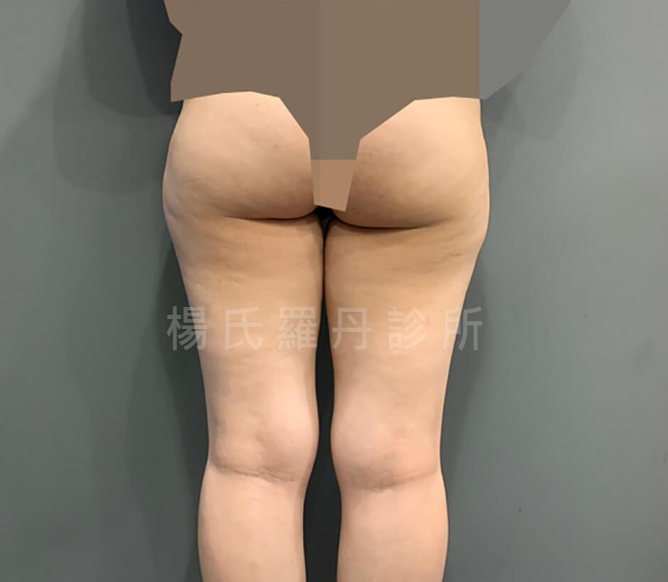 大腿抽脂 瘦大腿
