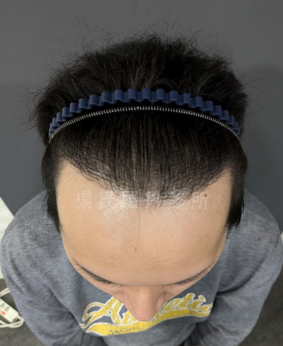 植髮 髮際線植髮