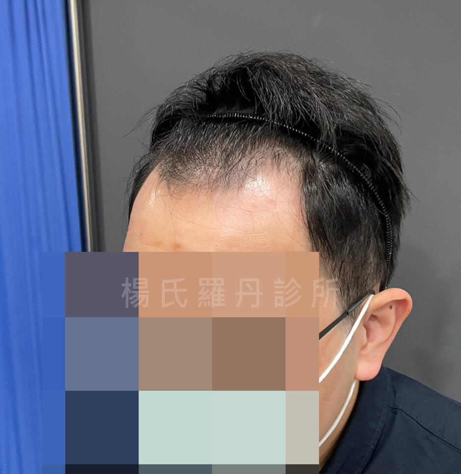 植髮 髮際線