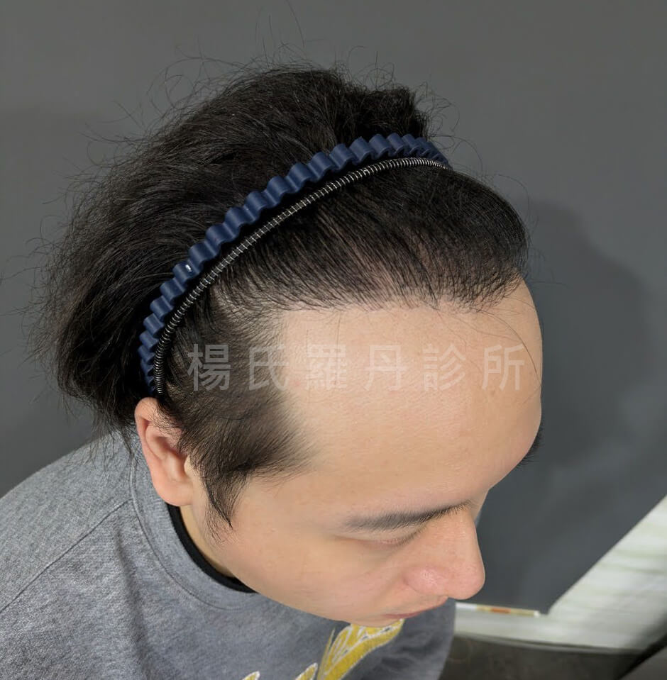 植髮手術 植髮