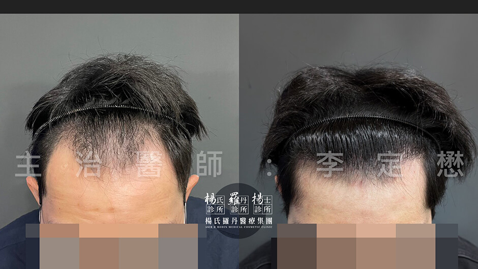 植髮 植髮手術 植髮效果
