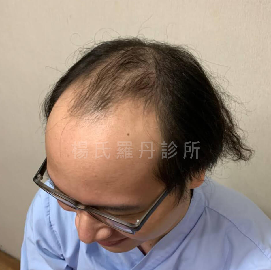 植髮 髮際線
