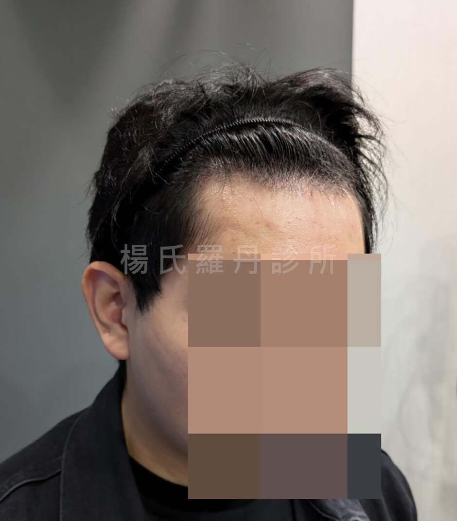 髮際線植髮 植髮
