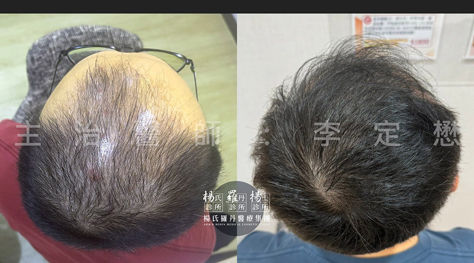 生髮 生髮療程 生髮效果