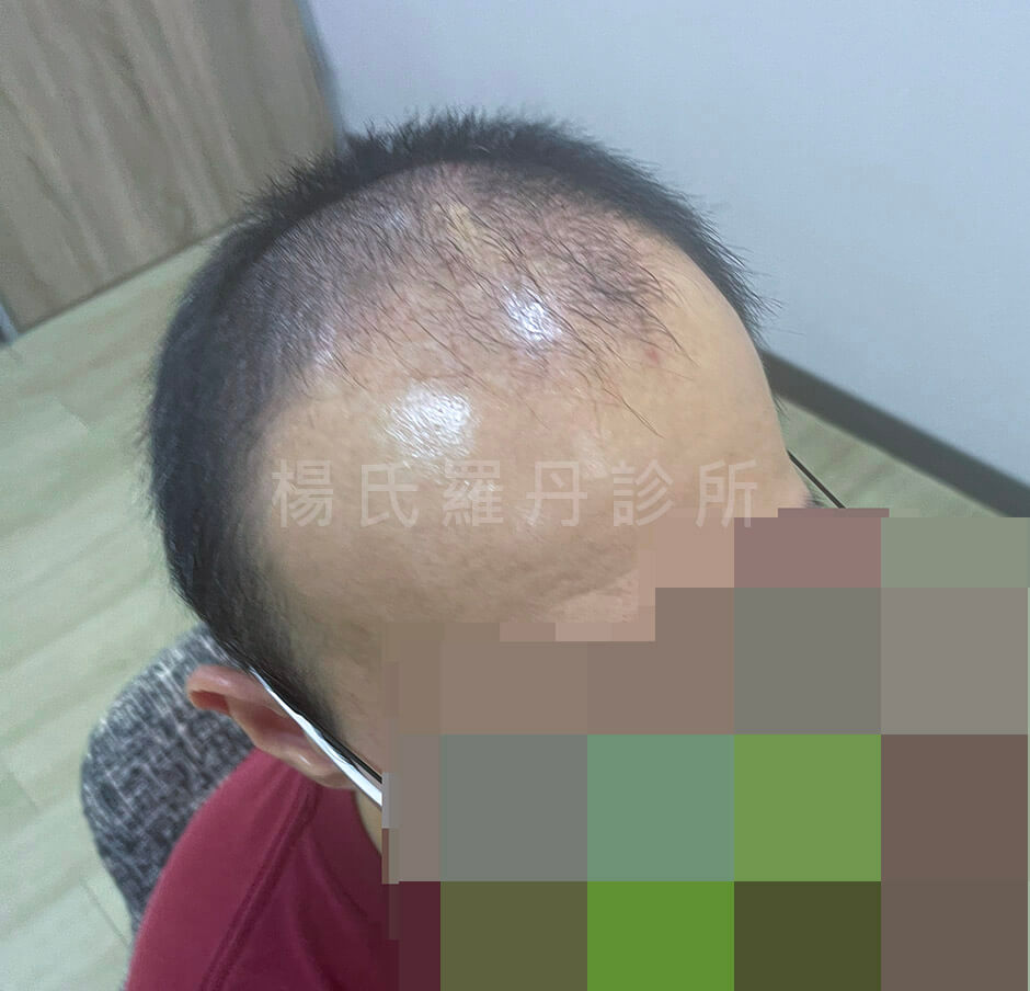 生髮 禿髮