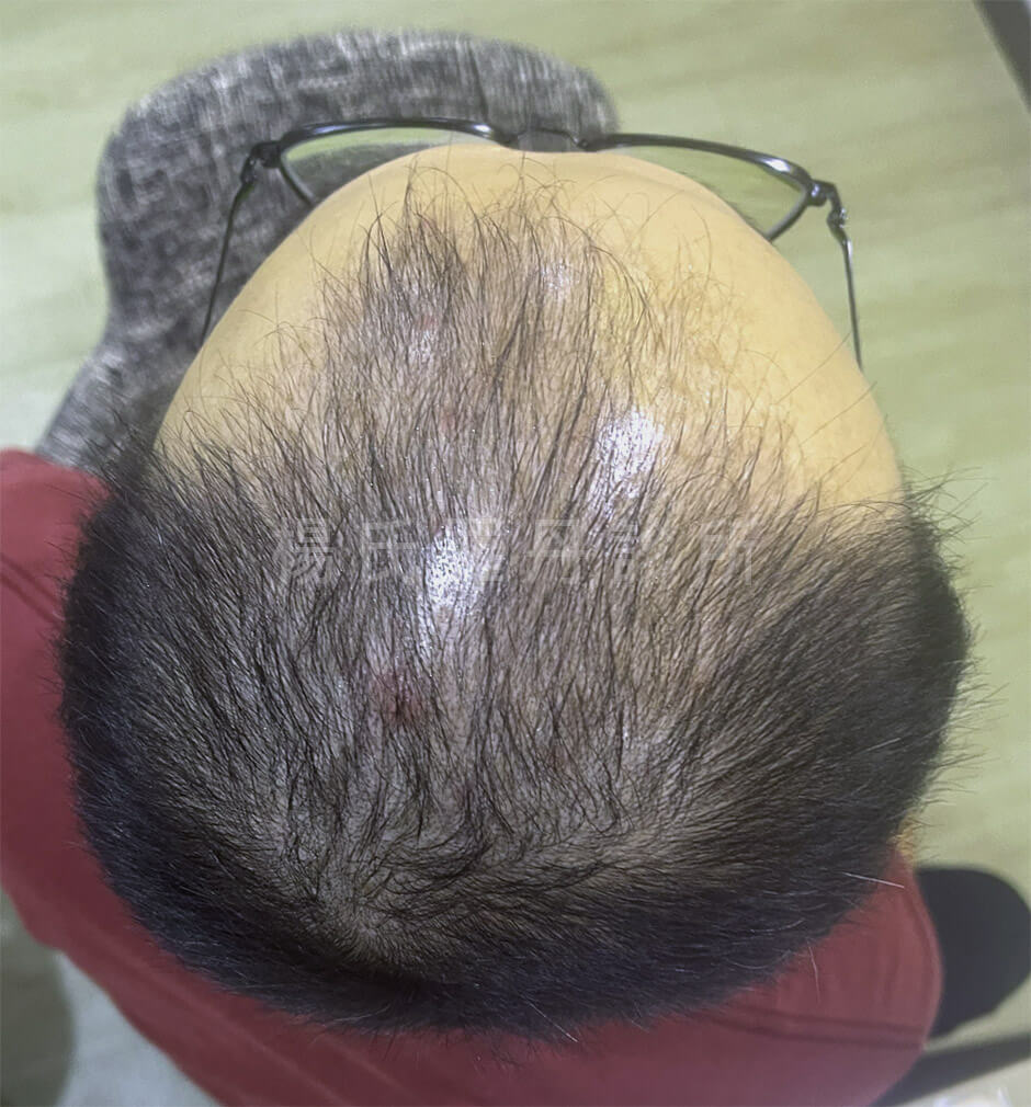 生髮 生髮療程