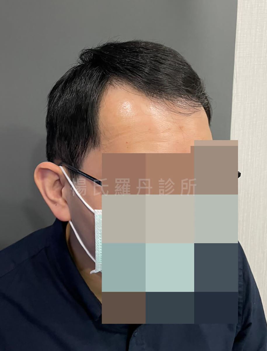 植髮 髮際線植髮