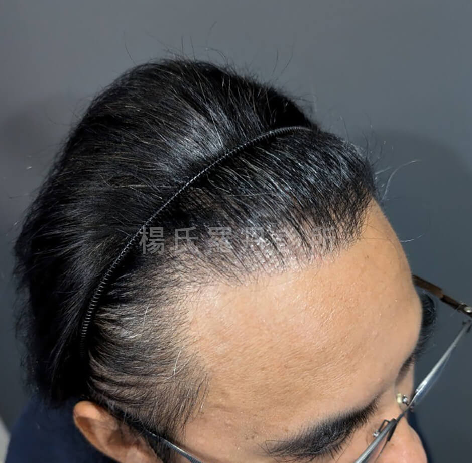 禿頭 植髮
