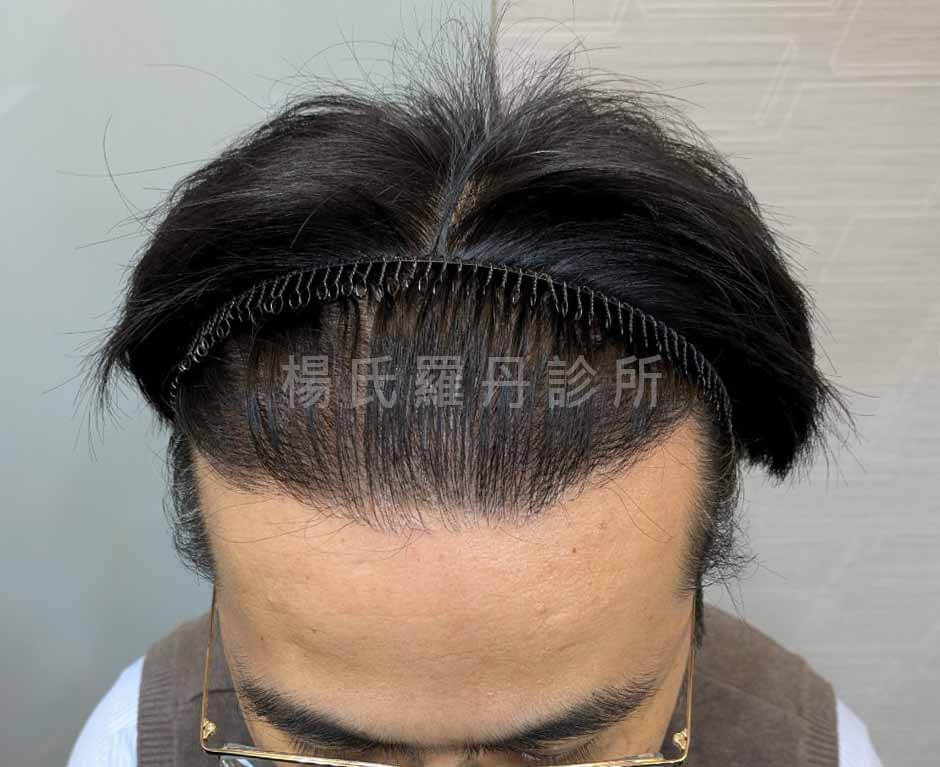 植髮 掉髮