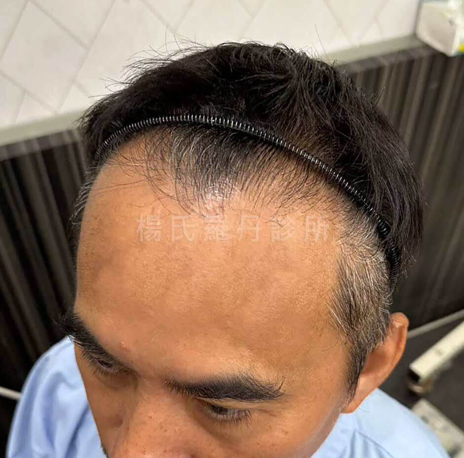 植髮 禿頭