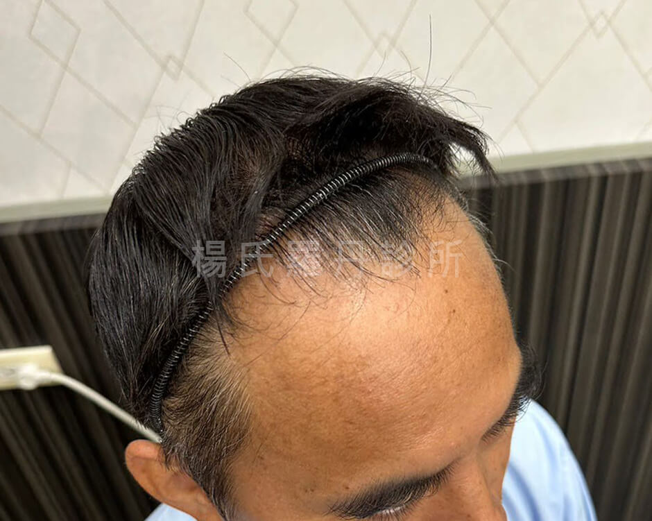 植髮 植髮效果