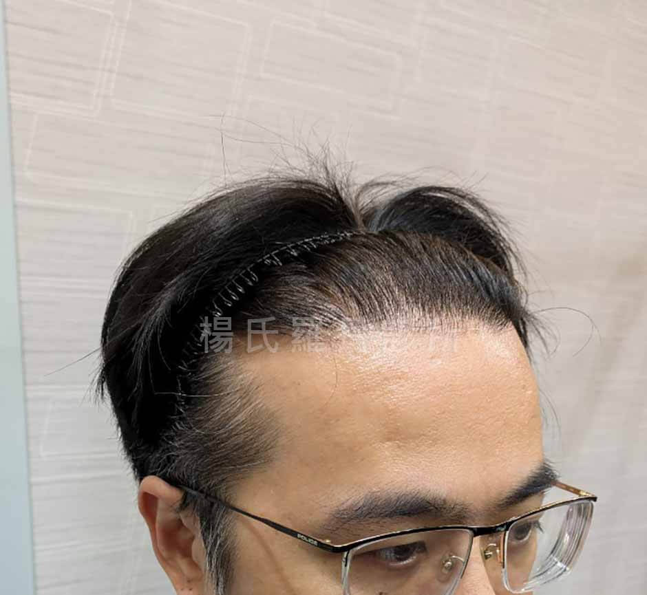 植髮 植髮效果