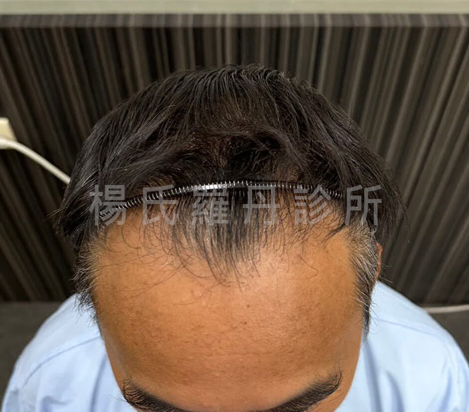 植髮 髮際線植髮