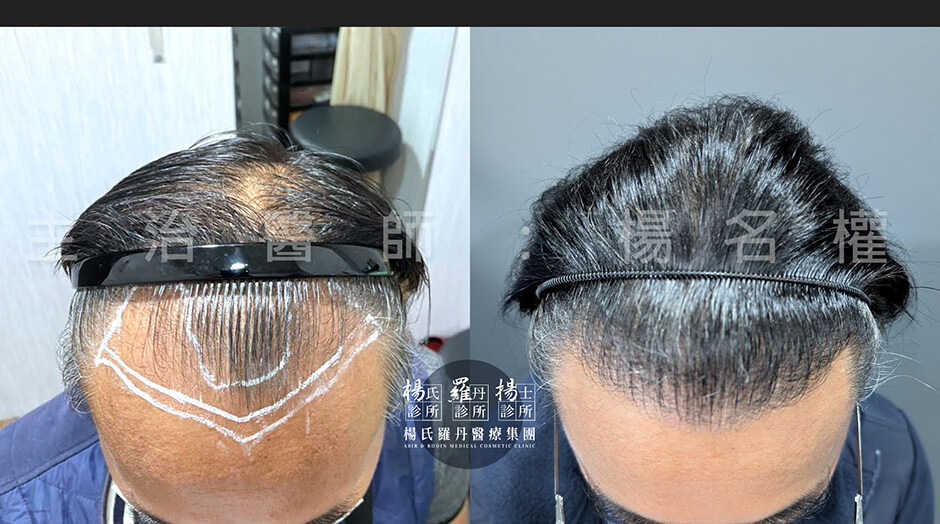 植髮 髮際線 禿頭