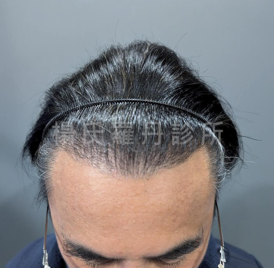 植髮 髮際線