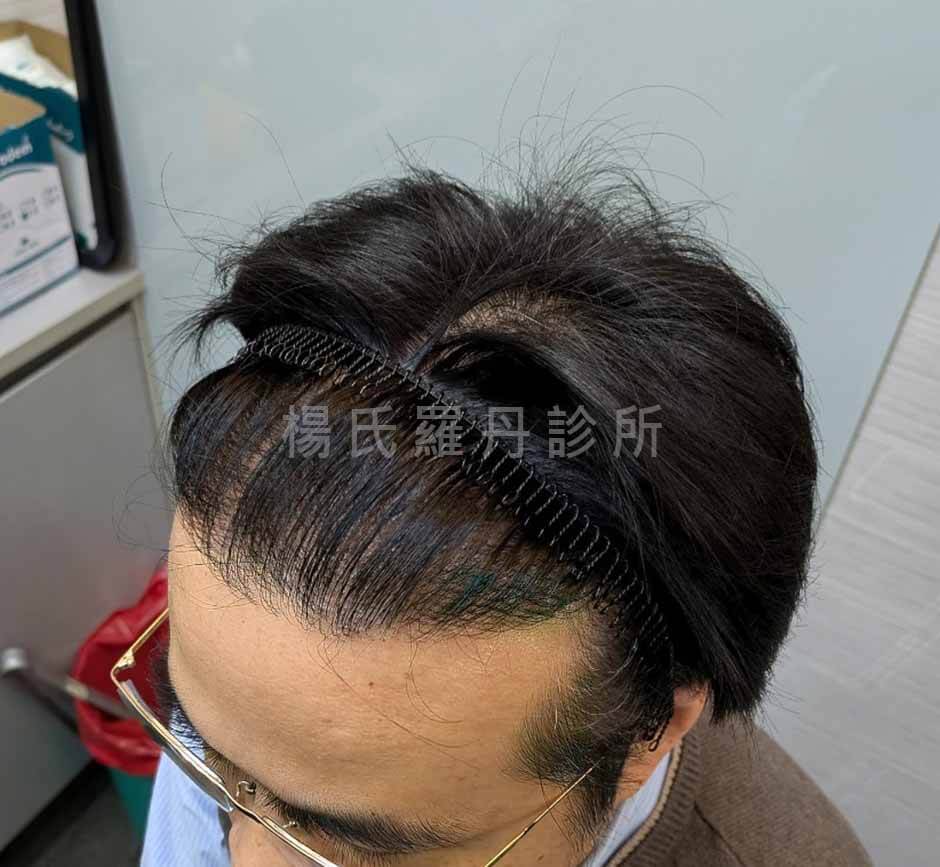 植髮效果 植髮