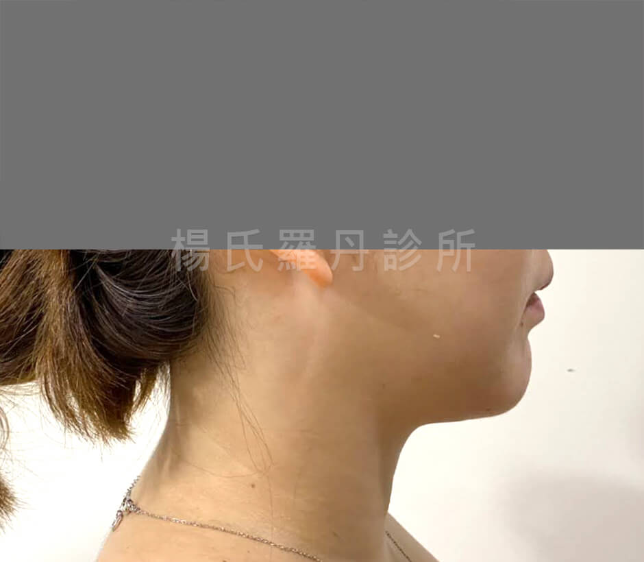 下巴抽脂 雷射減脂