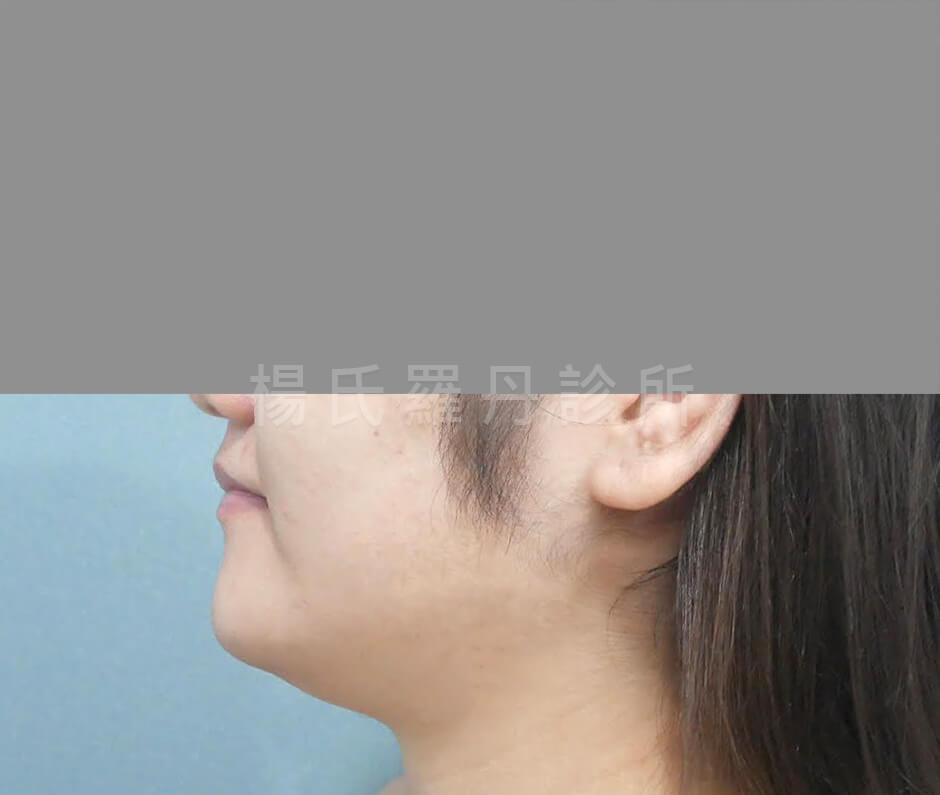 減脂手術 雷射減脂