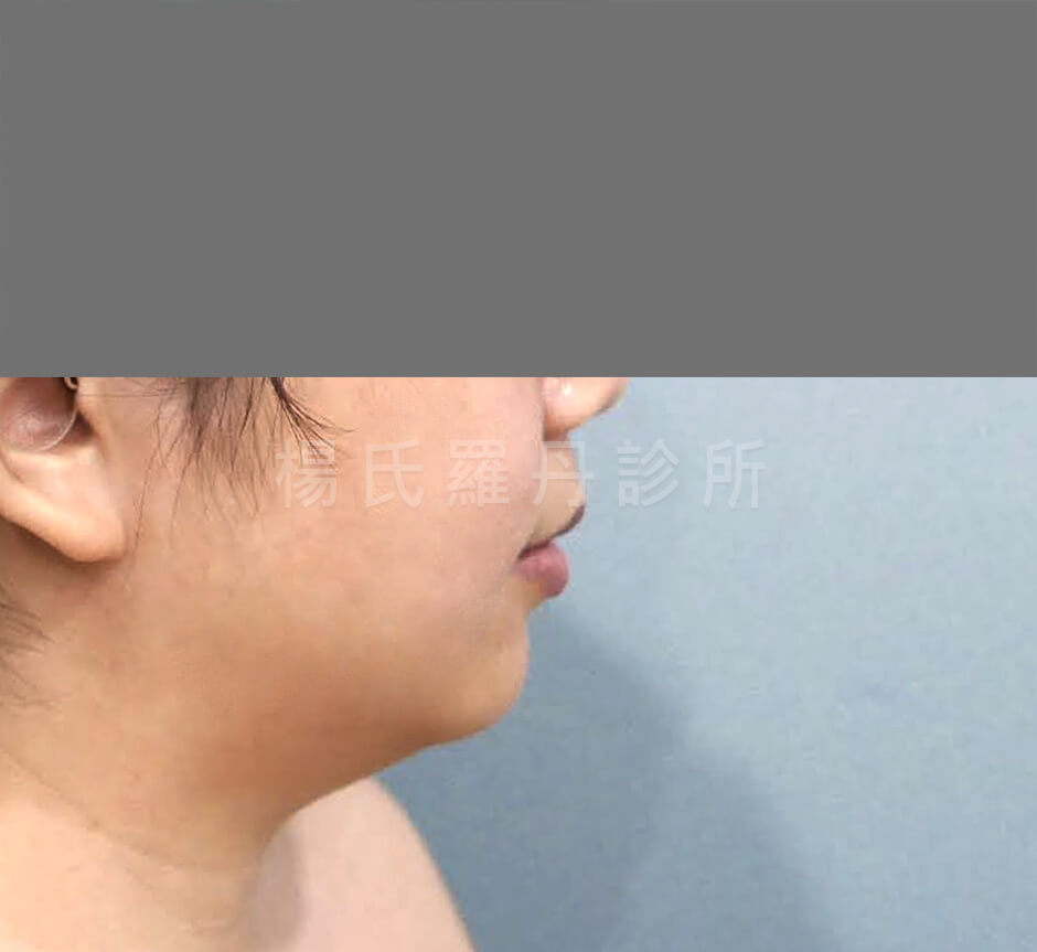 下巴抽脂 抽脂