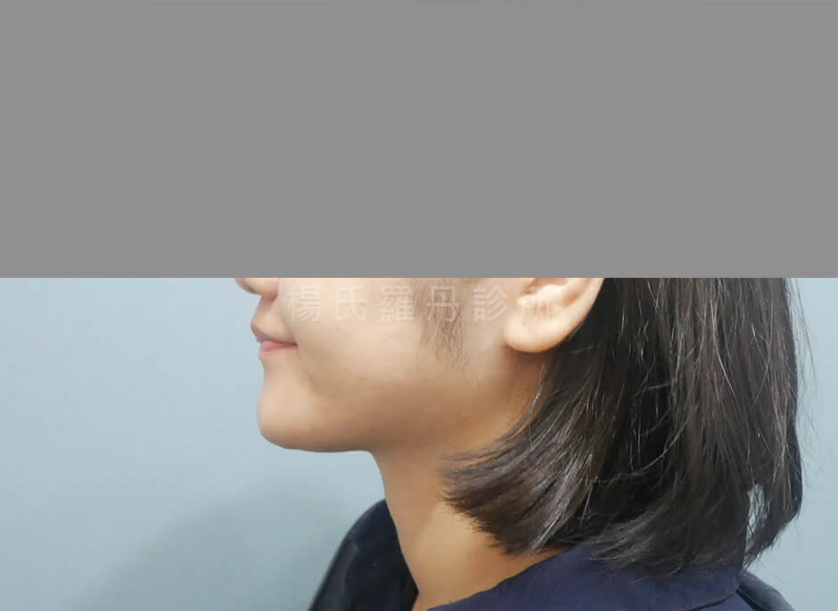 下巴抽脂 雷射減脂