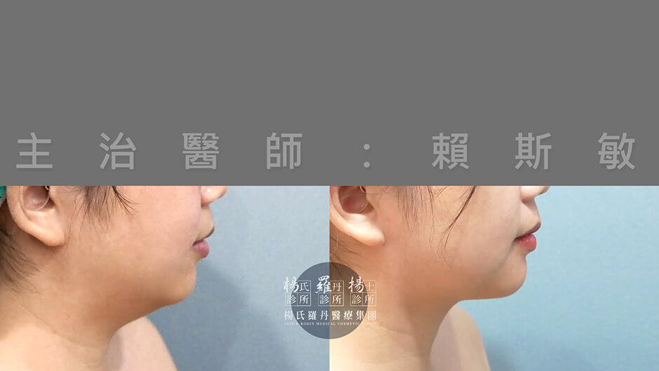 下巴抽脂 雙下巴 